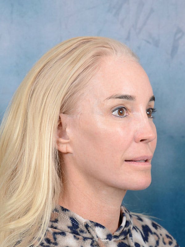 laser resurfacing