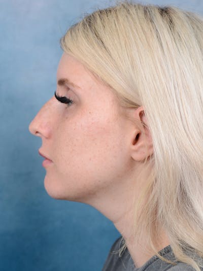 Rhinoplasty Before