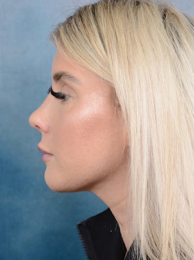 Rhinoplasty Before & After Gallery - Patient 95343938 - Image 2