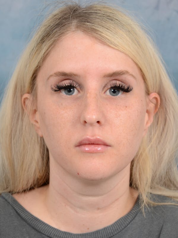 Rhinoplasty Before & After Gallery - Patient 95343938 - Image 3