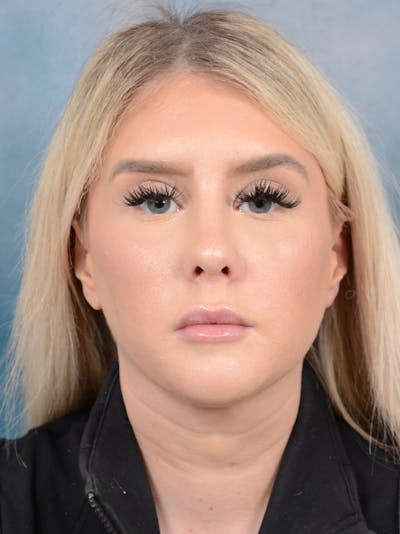 Rhinoplasty Before & After Gallery - Patient 95343938 - Image 4