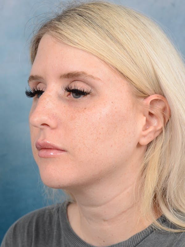Rhinoplasty Before & After Gallery - Patient 95343938 - Image 5