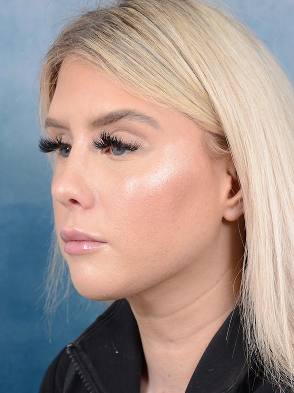 Rhinoplasty Before & After Gallery - Patient 95343938 - Image 6