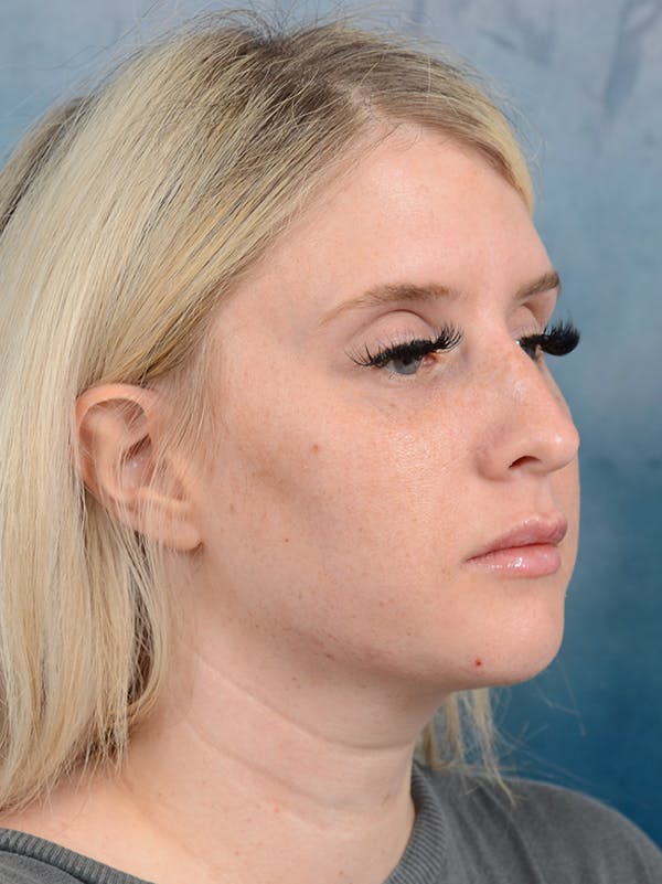 Rhinoplasty Before & After Gallery - Patient 95343938 - Image 7