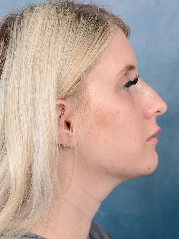 Neck Liposuction Before & After Gallery - Patient 95343940 - Image 9