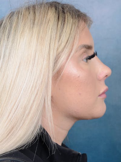 Neck Liposuction Before & After Gallery - Patient 95343940 - Image 10