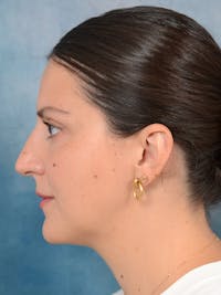 Rhinoplasty Before & After Gallery - Patient 95343949 - Image 1