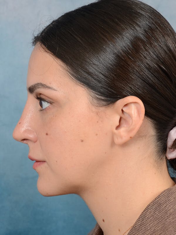 Rhinoplasty Before & After Gallery - Patient 95343949 - Image 2