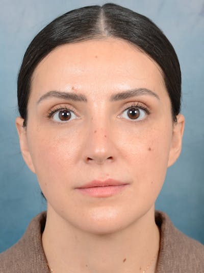 Brow Lift Before & After Gallery - Patient 95343953 - Image 2