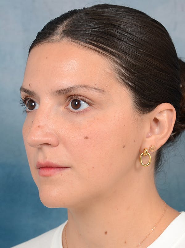 Rhinoplasty Before & After Gallery - Patient 95343949 - Image 5