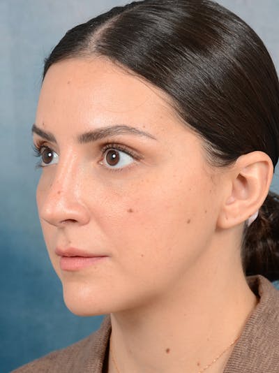 Brow Lift Before & After Gallery - Patient 95343953 - Image 6