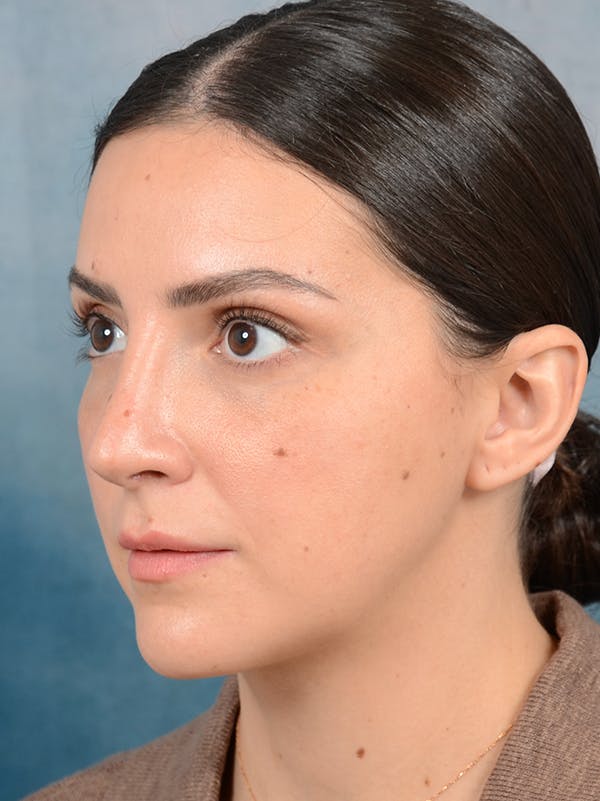 Rhinoplasty Before & After Gallery - Patient 95343949 - Image 6
