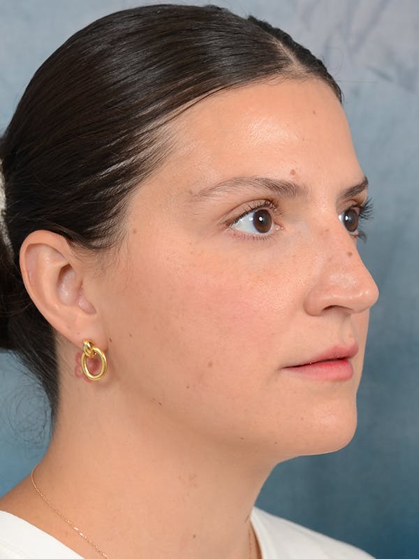 Rhinoplasty Before & After Gallery - Patient 95343949 - Image 7