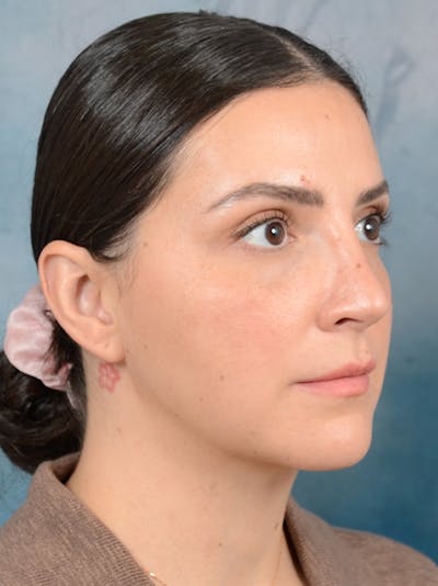 Brow Lift Before & After Gallery - Patient 95343953 - Image 8
