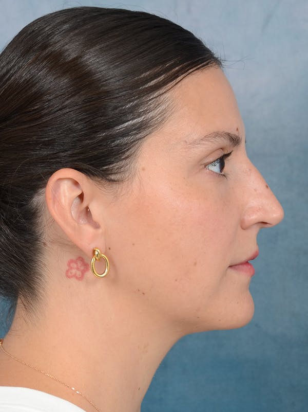 Rhinoplasty Before & After Gallery - Patient 95343949 - Image 9