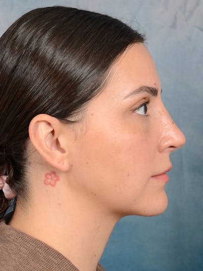 Rhinoplasty Before & After Gallery - Patient 95343949 - Image 10