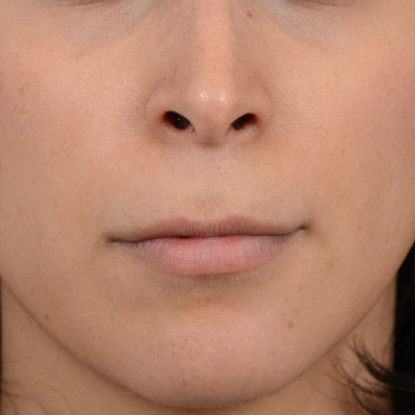 Lip Lift Before & After Gallery - Patient 99666016 - Image 1