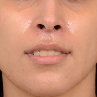 Lip Lift Before & After Gallery - Patient 99666016 - Image 2