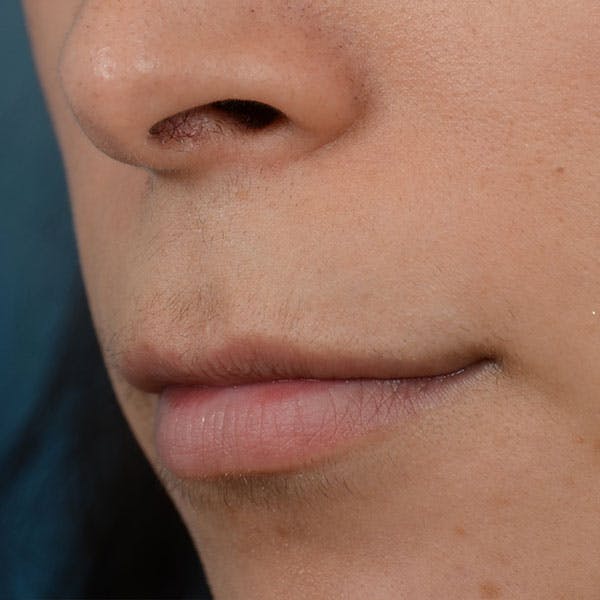 Lip Lift Before & After Gallery - Patient 99666016 - Image 3