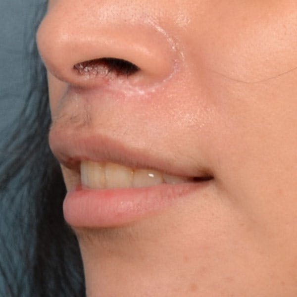 Lip Lift Before & After Gallery - Patient 99666016 - Image 4