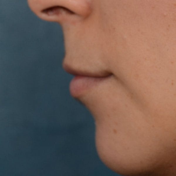 Lip Lift Before & After Gallery - Patient 99666016 - Image 5