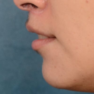 Lip Lift Before & After Gallery - Patient 99666016 - Image 6