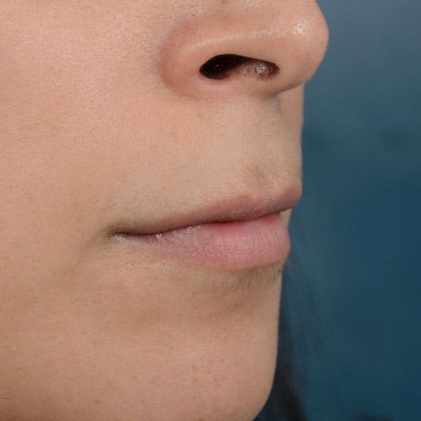 Lip Lift Before & After Gallery - Patient 99666016 - Image 7