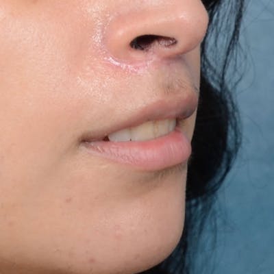 Lip Lift Before & After Gallery - Patient 99666016 - Image 8