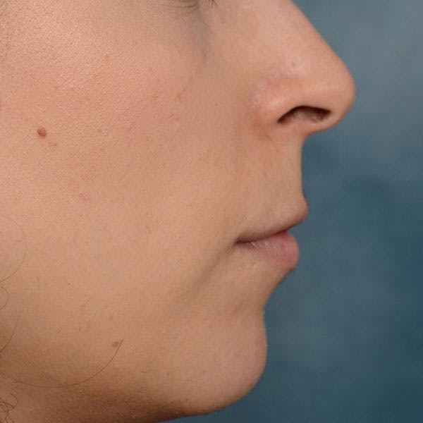 Lip Lift Before & After Gallery - Patient 99666016 - Image 9