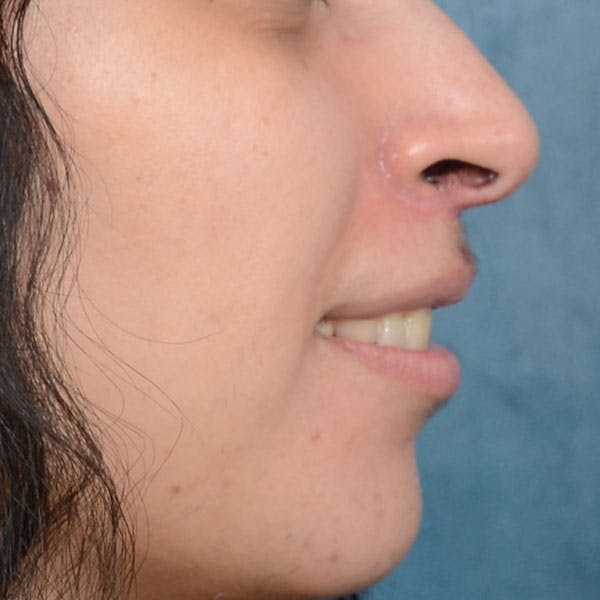 Lip Lift Before & After Gallery - Patient 99666016 - Image 10