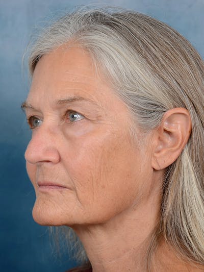 laser resurfacing