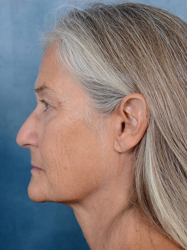 laser resurfacing