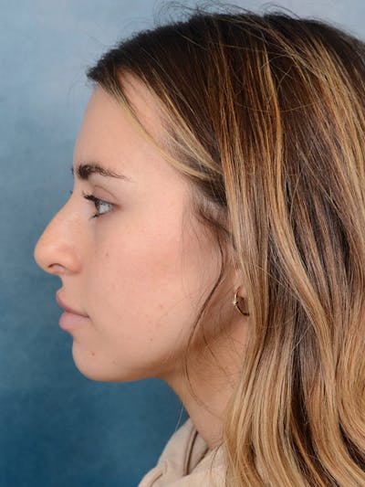 Rhinoplasty Before & After Gallery - Patient 100437121 - Image 1
