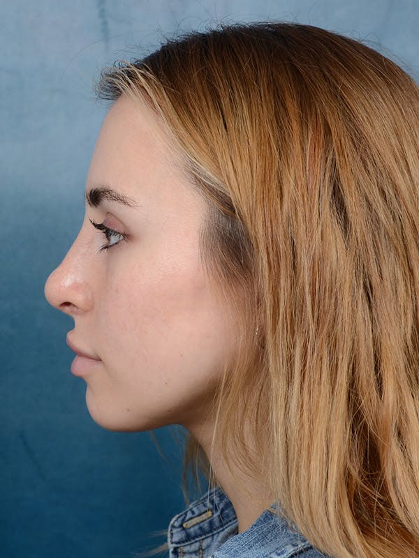 Rhinoplasty Before & After Gallery - Patient 100437121 - Image 2
