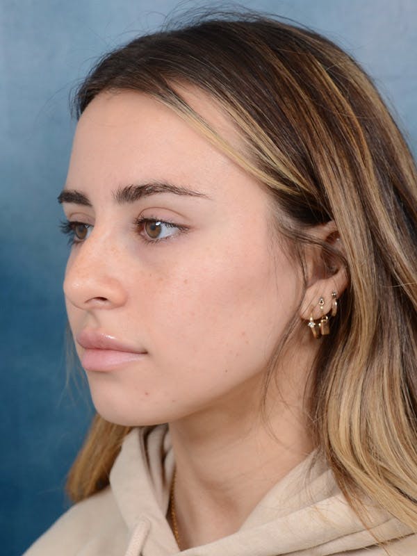 Rhinoplasty Before & After Gallery - Patient 100437121 - Image 5