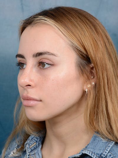 Rhinoplasty Before & After Gallery - Patient 100437121 - Image 6