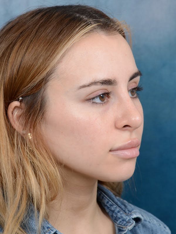 Rhinoplasty Before & After Gallery - Patient 100437121 - Image 8