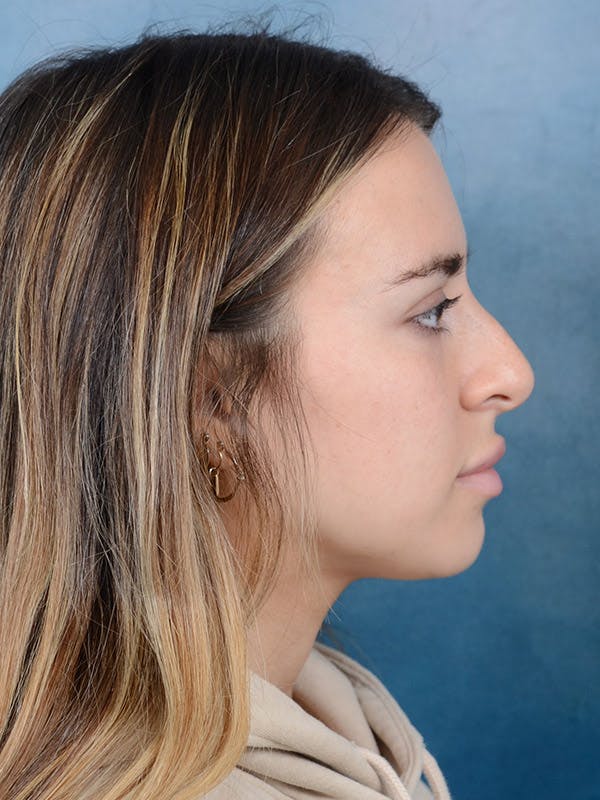 Rhinoplasty Before & After Gallery - Patient 100437121 - Image 9