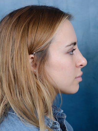 Rhinoplasty Before & After Gallery - Patient 100437121 - Image 10