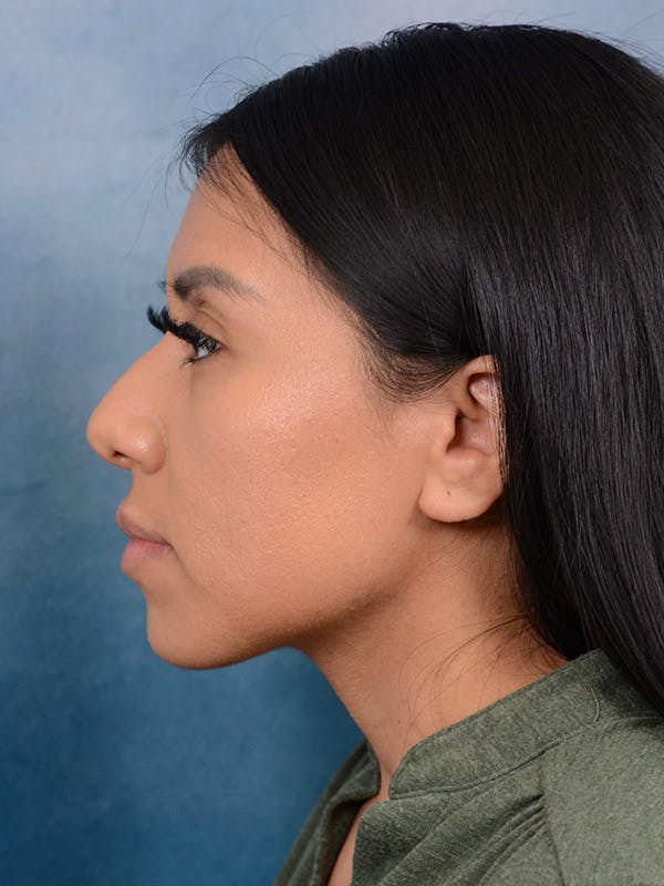 Rhinoplasty Before & After Gallery - Patient 101369280 - Image 1