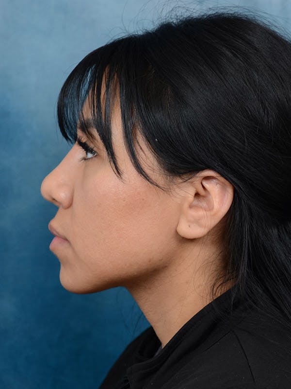 Rhinoplasty Before & After Gallery - Patient 101369280 - Image 2