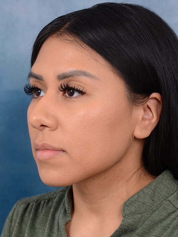 Rhinoplasty Before & After Gallery - Patient 101369280 - Image 3