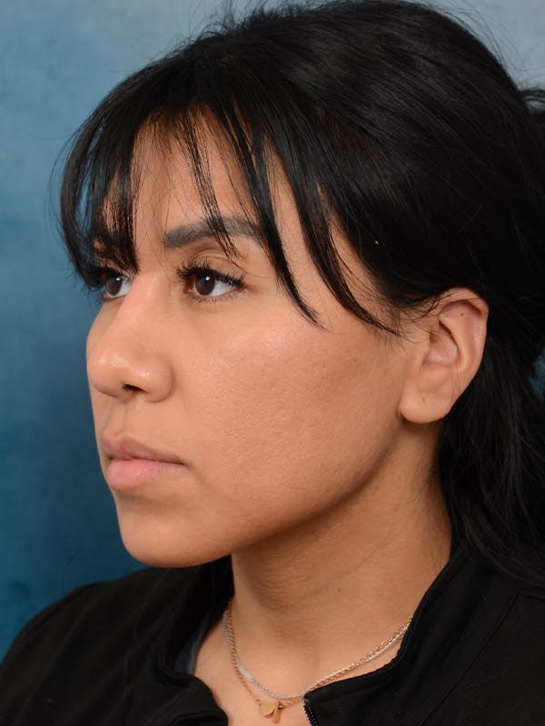 Rhinoplasty Before & After Gallery - Patient 101369280 - Image 4