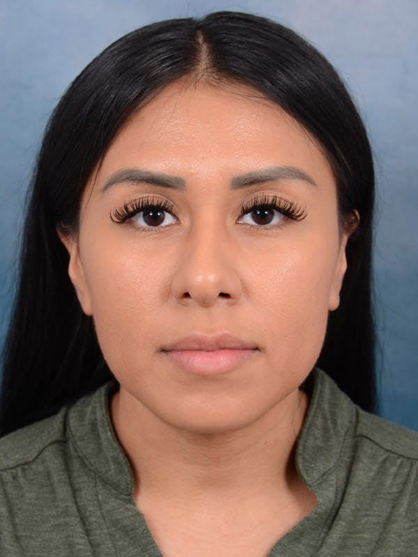 Rhinoplasty Before & After Gallery - Patient 101369280 - Image 5