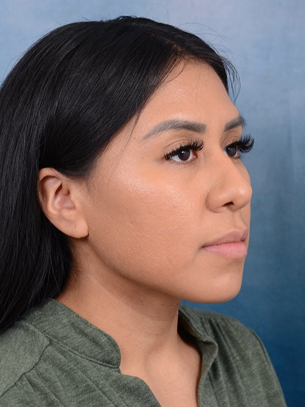 Rhinoplasty Before & After Gallery - Patient 101369280 - Image 7