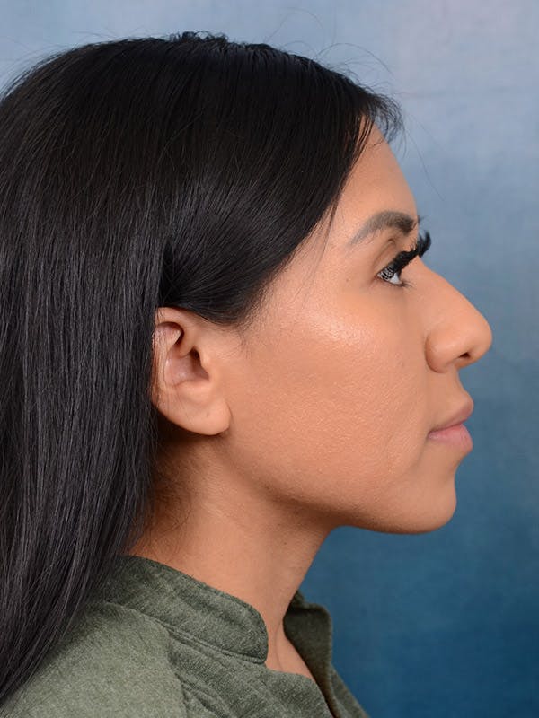 Rhinoplasty Before & After Gallery - Patient 101369280 - Image 9