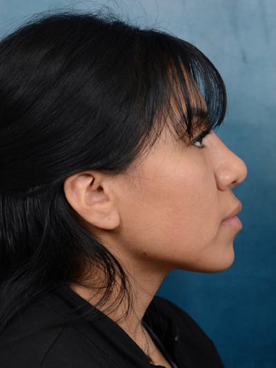 Rhinoplasty Before & After Gallery - Patient 101369280 - Image 10