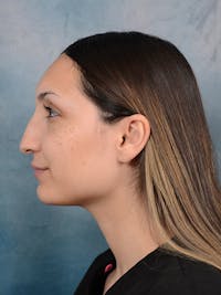 Rhinoplasty Before & After Gallery - Patient 101369578 - Image 1