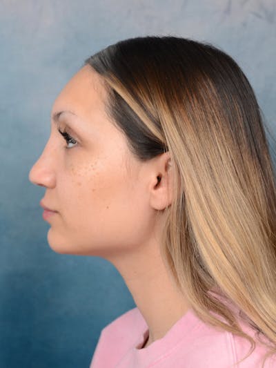 Rhinoplasty Before & After Gallery - Patient 101369578 - Image 2