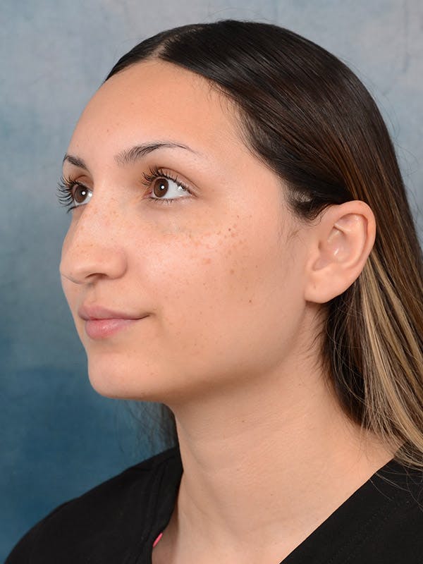 Rhinoplasty Before & After Gallery - Patient 101369578 - Image 3